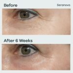 Micro Infusion Patches - Image 7