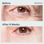 Micro Infusion Patches - Image 2