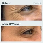 Micro Infusion Patches - Image 3