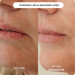 The Microneedling Infusion System™ - Image 2