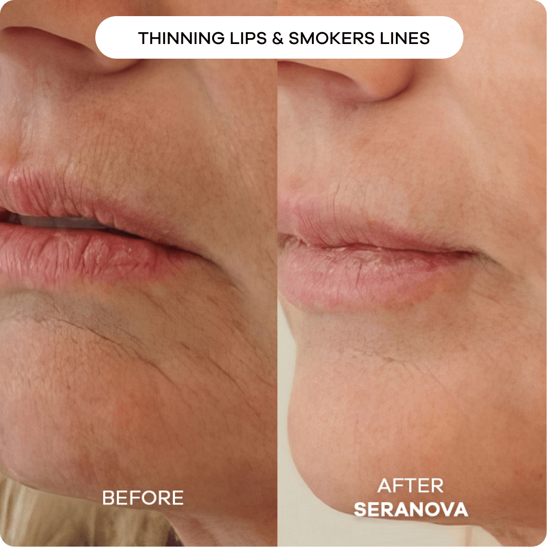 the-microneedling-infusion-system-144113.png The Microneedling Infusion System™ - Image 2