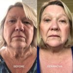The Microneedling Infusion System™ - Image 10