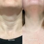 The Microneedling Infusion System™ - Image 13