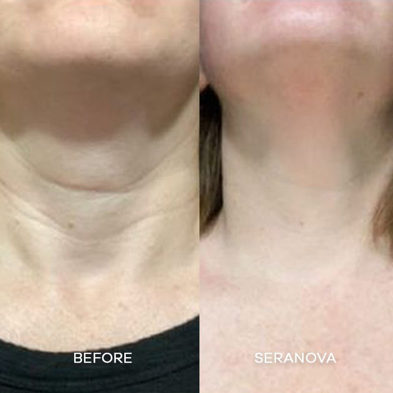 the-microneedling-infusion-system-237996.jpg The Microneedling Infusion System™ - Image 13