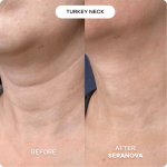 The Microneedling Infusion System™ - Image 4