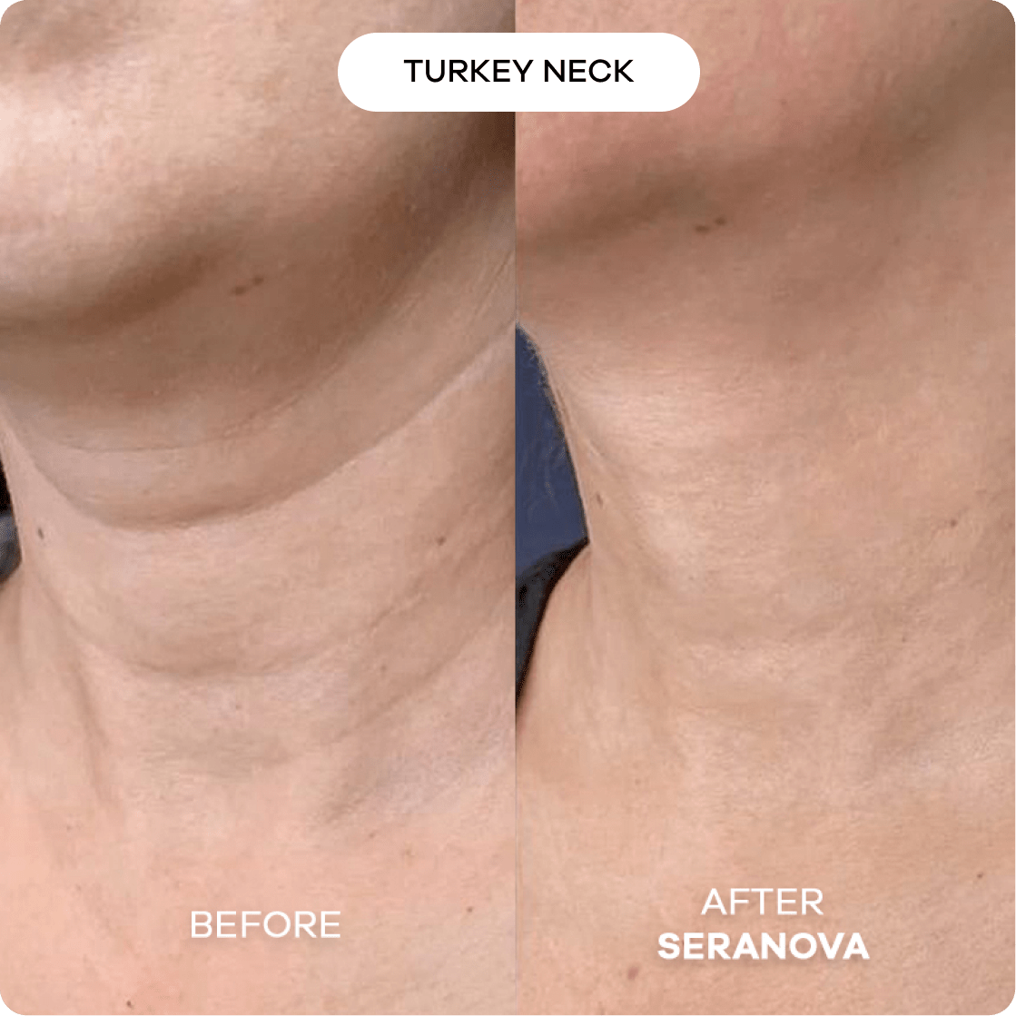 the-microneedling-infusion-system-483215.png The Microneedling Infusion System™ - Image 4