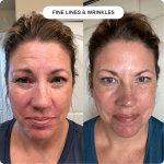 The Microneedling Infusion System™ - Image 3