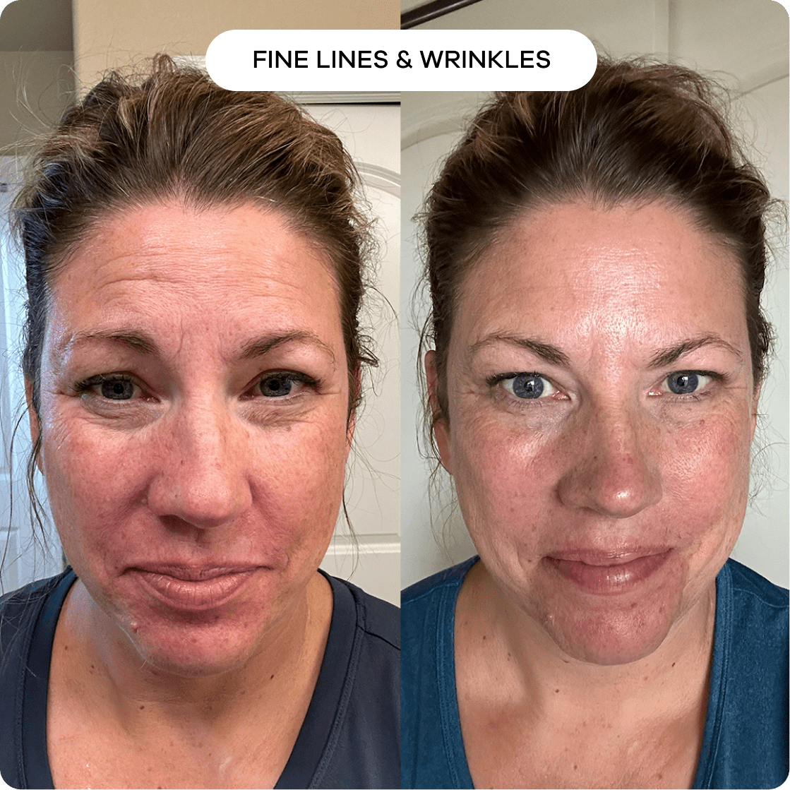 the-microneedling-infusion-system-578187.png The Microneedling Infusion System™ - Image 3