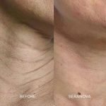 The Microneedling Infusion System™ - Image 12