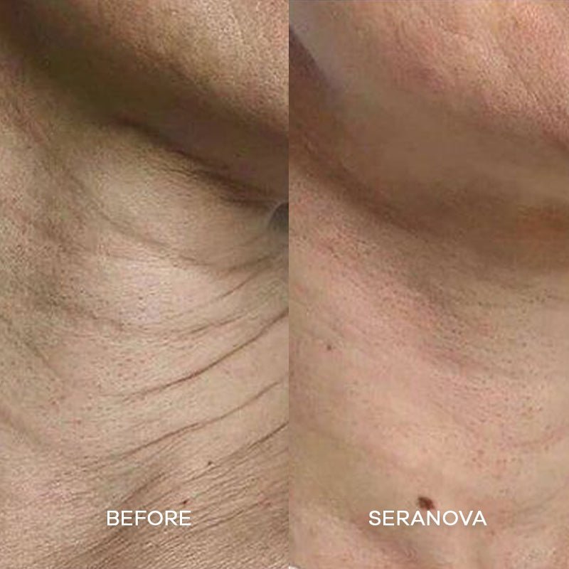 the-microneedling-infusion-system-771514.jpg The Microneedling Infusion System™ - Image 12