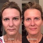 The Microneedling Infusion System™ - Image 9