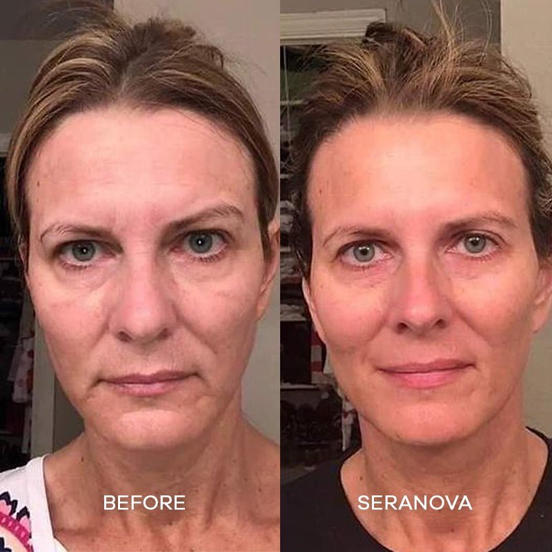 the-microneedling-infusion-system-802481.jpg The Microneedling Infusion System™ - Image 9